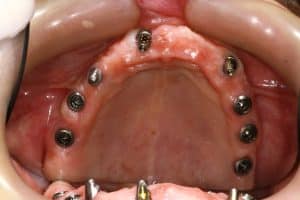 מהלך השתלת שיניים במרפאת ד"ר מיכאל דרייר – תהליך כירורגי מקצועי