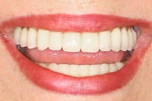 הלסת אחרי השתלת שיניים – תוצאה במרפאה