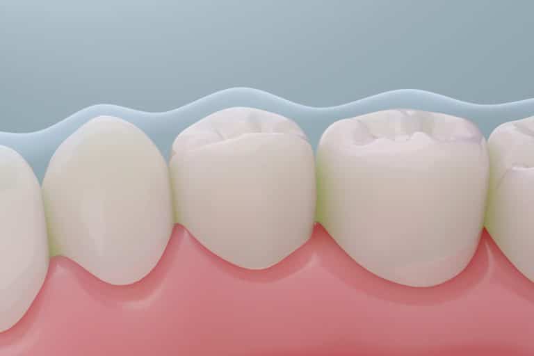 ציפויים לשיניים