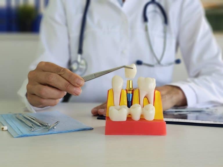 כמה עולה שתל בשיניים